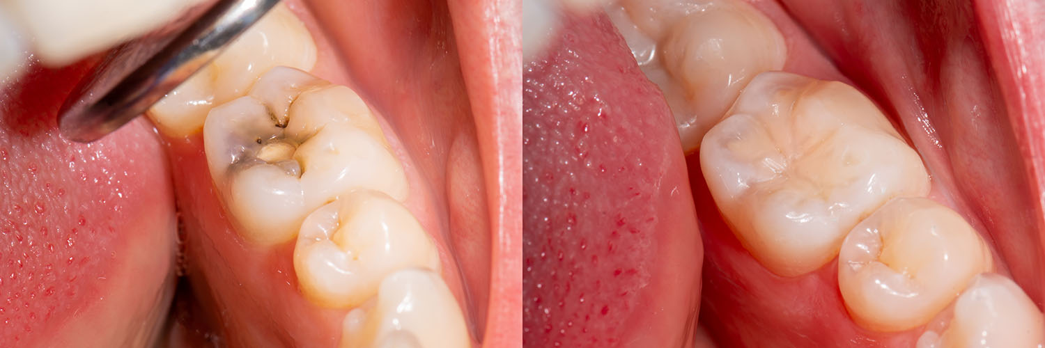 The image shows a close-up view of an open mouth with multiple teeth being pulled out, displaying the process of extraction.