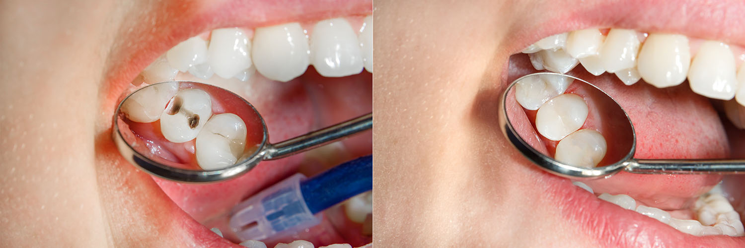 This image shows a close-up of a person s mouth with a toothbrush inside, displaying an open smile revealing teeth and a dental implant, with a humorous twist where the person s tongue appears to be in the shape of a smiley face.