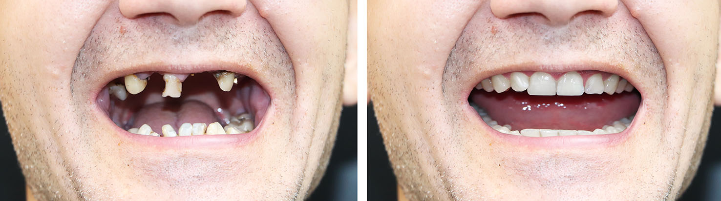 The image shows a person with a wide open mouth displaying multiple teeth, which appears to be a composite of two photos, possibly for humorous effect, with an alt tag that could read A man s mouth with exaggeratedly large teeth in a humorous collage.