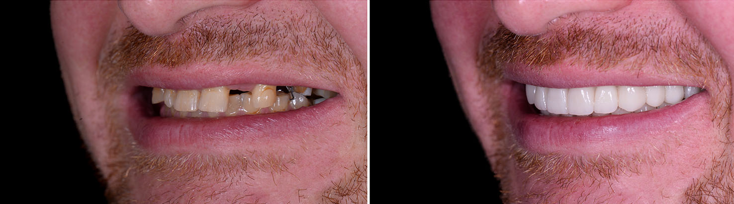 The image shows a split-screen comparison of a person s teeth before and after dental treatment, with the left side showing yellowed teeth and the right side showing clean, white teeth.